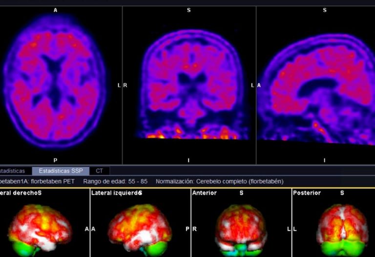 La importancia de un estudio PET/CT en el diagnóstico de una demencia ...